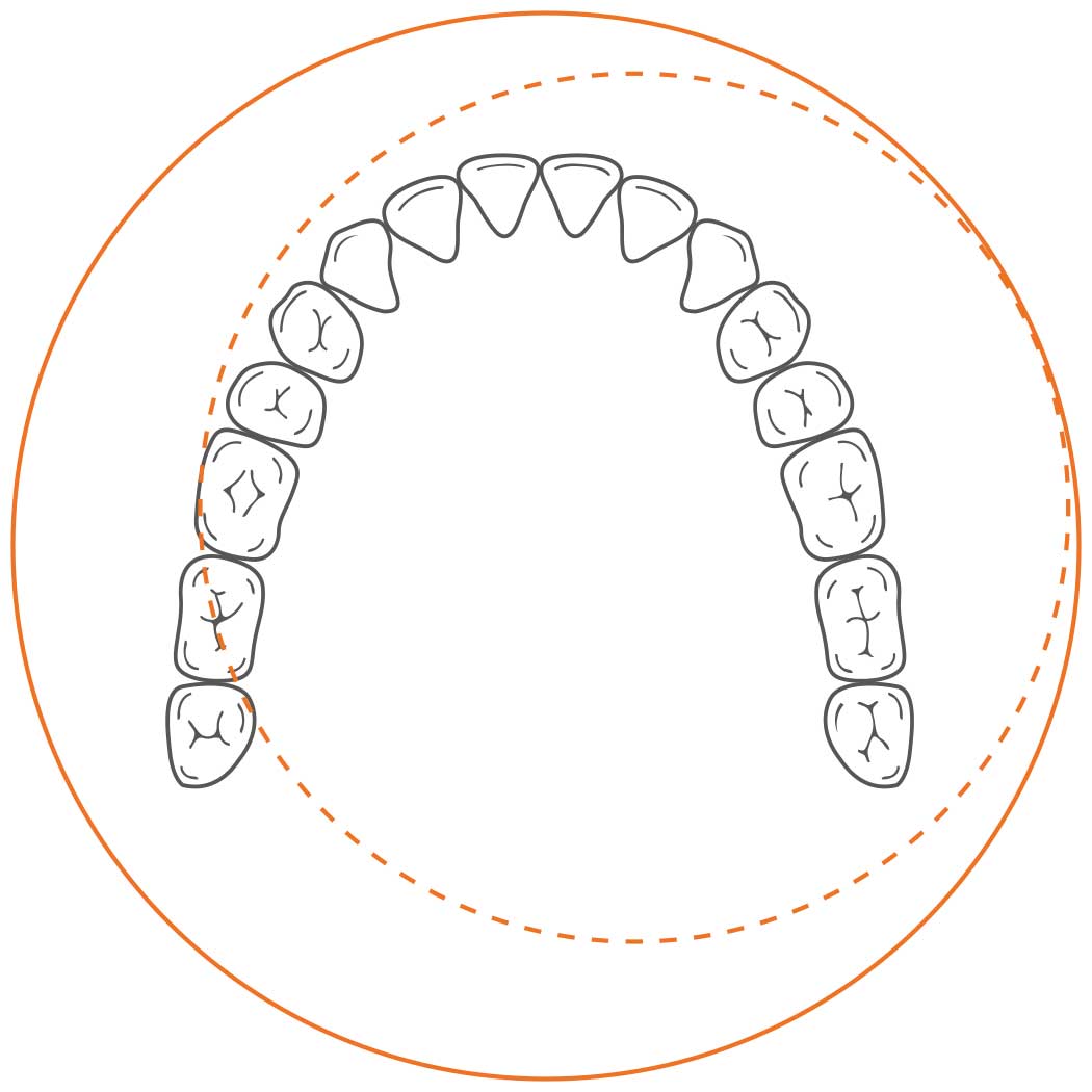 orangedental Lupenbrille opt-on 3,3 ttl