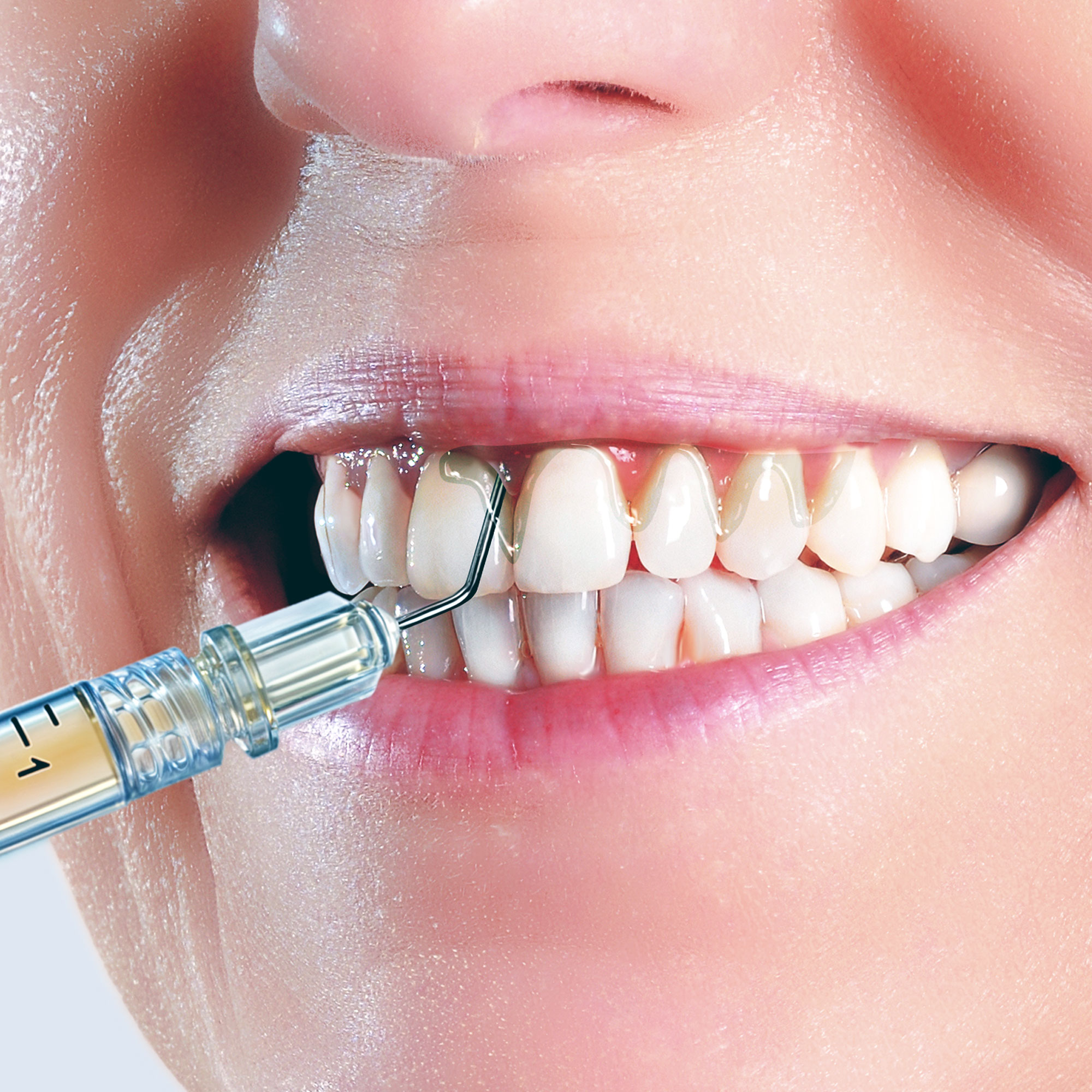 AKTION: 2 x Sterify Gel 0,3 ml Spritze + 1 x PCP11.5B6 Parodontometer WHO #11.5B Gr #6 Qulix